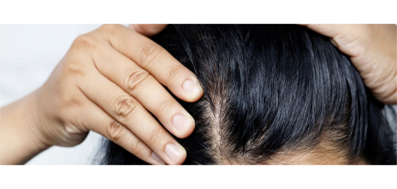 Treating Hair Loss: What You Need to Know